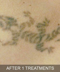 Tattoo Removal After