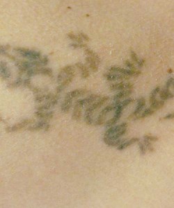 Tattoo Removal After