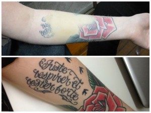 Tattoo Removals Auckland