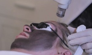 Carbon Laser Facial Treatment